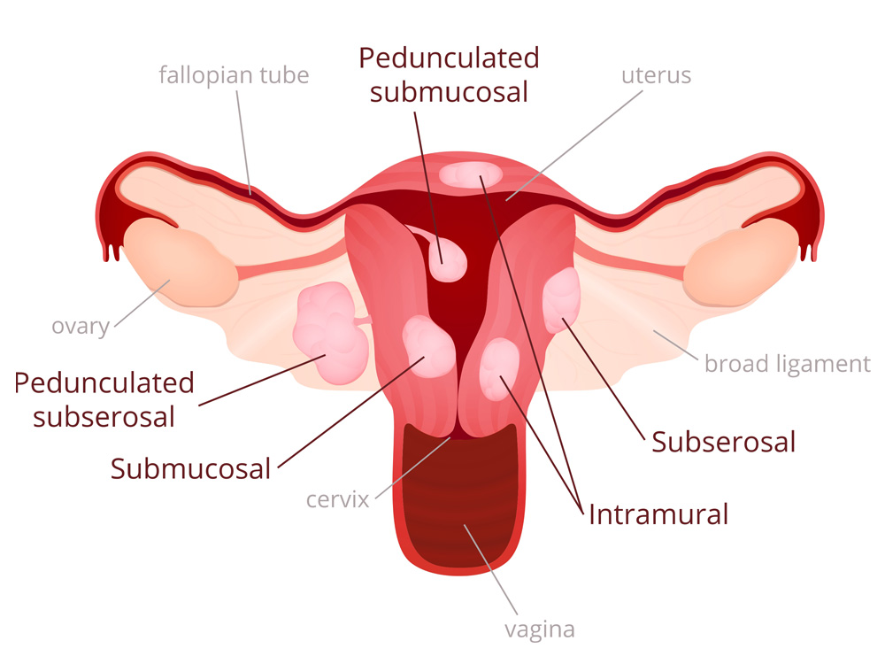 Uterine-fibroids_diagram