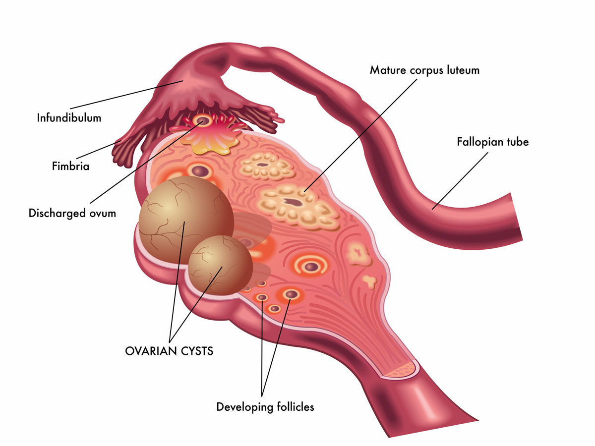 ovarian_cyst_lr2
