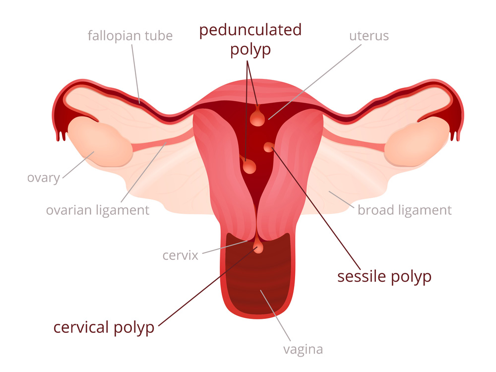 uterine_polyps_diagram